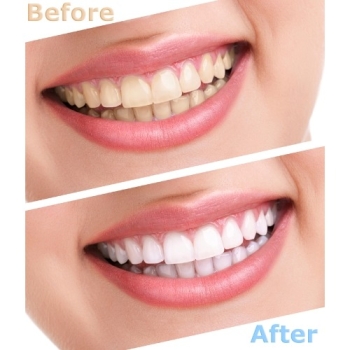 Preview: Insmile Bleaching Gel Preview: Zähne vor und nach einer Insmile Bleaching Behandlung